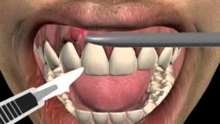 How to treat a tooth abscess [upl. by Furmark]