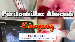 Peritonsillar Abscess Emergency and Needle Aspiration [upl. by Pyne398]