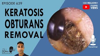 639  Keratosis Obturans Removal [upl. by Annaul]