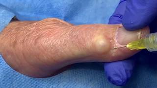 Ganglion Cyst Jelly Doughnut Hole Extraction [upl. by Norok443]