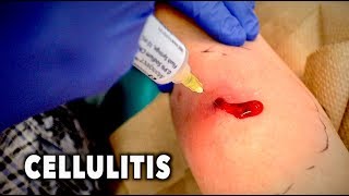 ABSCESS WITH CELLULITIS We had to drain it  Dr Paul [upl. by Market]