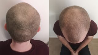 Pumpkin Seed Oil for Hair Loss 24 Week Experiment [upl. by Ryon]