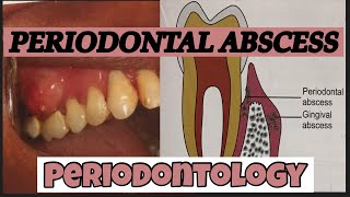 PERIODONTAL ABSCESS II PERIODONTOLOGY [upl. by Nottage]