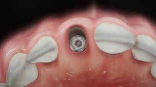 Straumann® BLX  Immediate anterior implant placement [upl. by Eisdnyl]