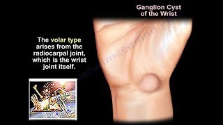 Ganglion Cyst Wrist  Everything You Need To Know  Dr Nabil Ebraheim [upl. by Marney]