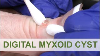 We love a Digital Myxoid Cyst  Dr Derm [upl. by Ahsiki166]