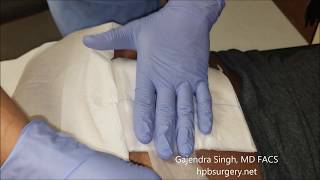 Change Dressing Pilonidal Abscess Wound at Home [upl. by Stacy72]