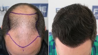 FUE Hair Transplant 4766 Grafts NW V By Dr Juan Couto  FUEXPERT CLINIC Madrid Spain [upl. by Ylrevaw]