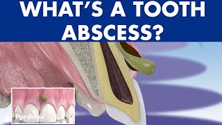 TOOTH ABSCESS dental infection  PHLEGMON symptoms and treatment © [upl. by Heymann]