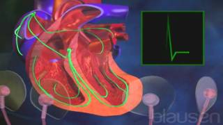 Fibrilación auricular [upl. by Asiuol539]