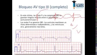 Arritmias en el electrocardiograma [upl. by Rostand]