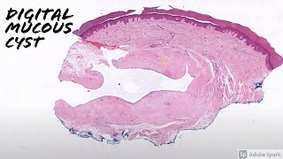 Digital Mucous Cyst vs Ganglion Cyst 5Minute Pathology Pearls [upl. by Ransom]