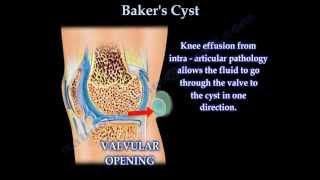 Bakers Cyst  Everything You Need To Know  Dr Nabil Ebraheim [upl. by Hodges623]