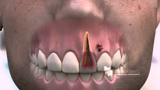 How to treat a dental Fistula [upl. by Anabal]