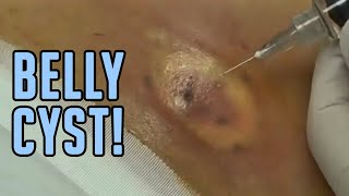 The Tummy Cyst  Busted [upl. by Silra]