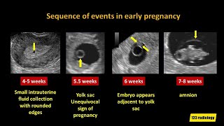 Early Pregnancy Failure A simplified Ultrasound Approach [upl. by Hali]