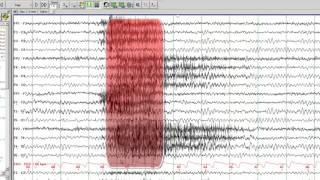 EEG in Juvenile Myoclonic Epilepsy [upl. by Perretta564]